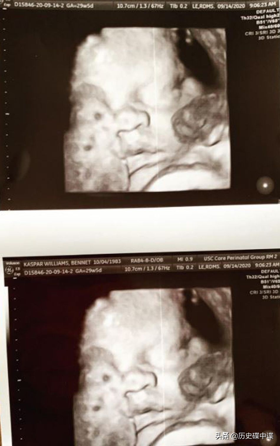 美国女子变性后诞下一子,美国变性手术生孩子