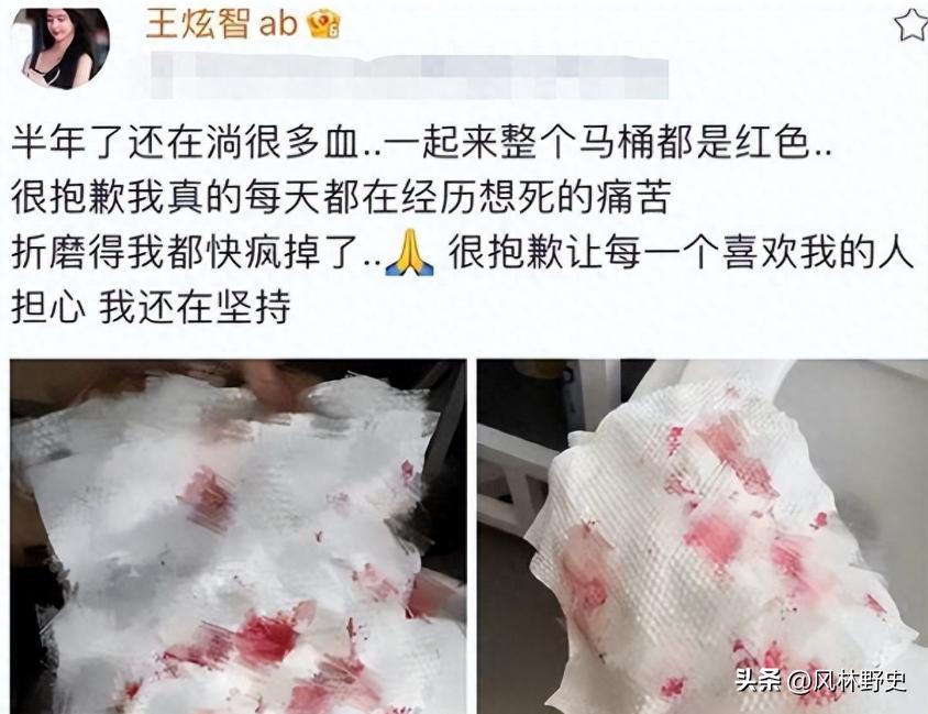 网红变性后遗症,网红变性36天痊愈