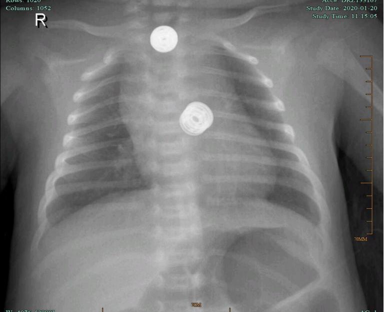 新生儿支气管肺炎的治疗方法,新生儿吸入性肺炎如何治疗