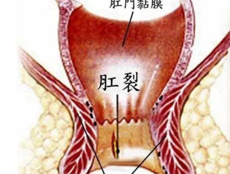警惕肛裂带来的危害,肛裂为什么以年轻女性为主