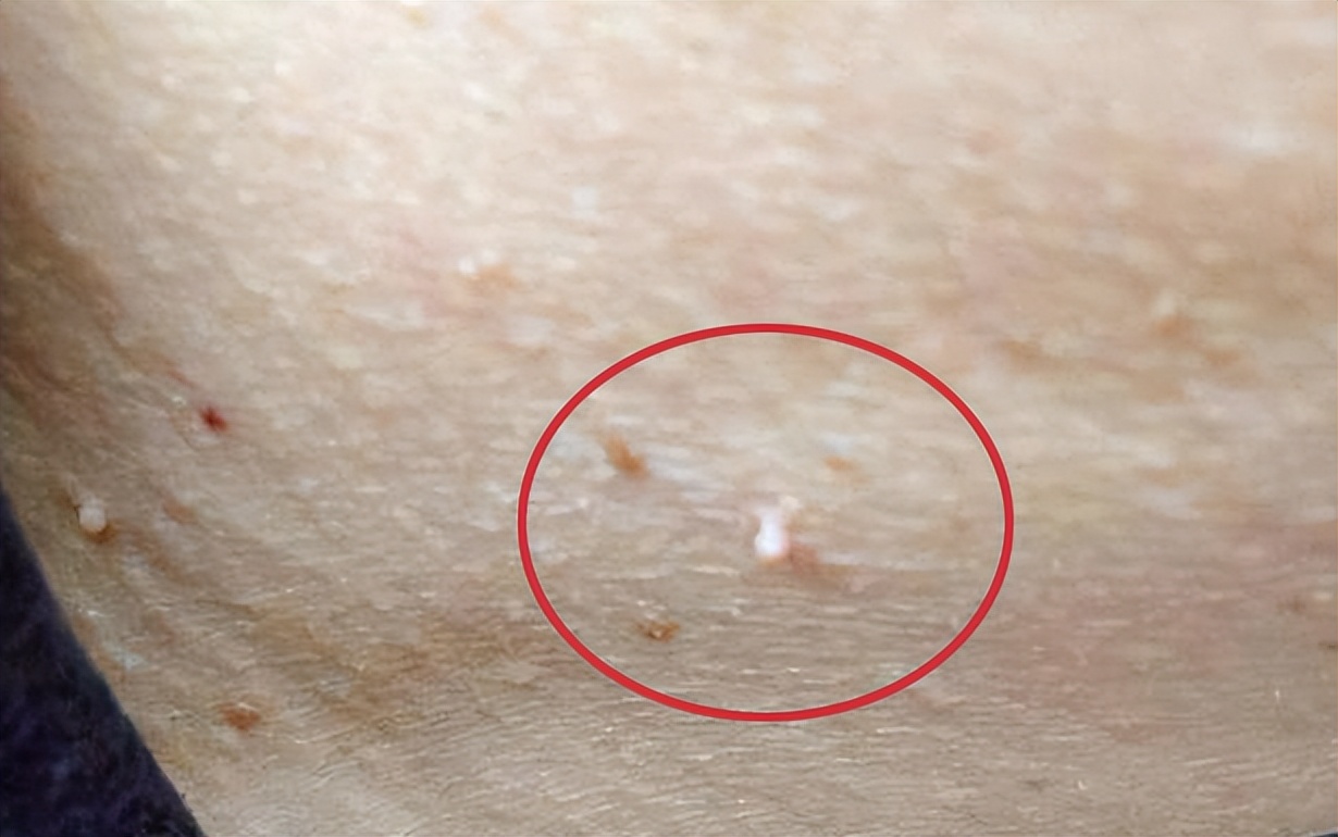 眼睛脖子眼皮有小肉粒是hpv吗,眼睛上的小肉粒是hpv