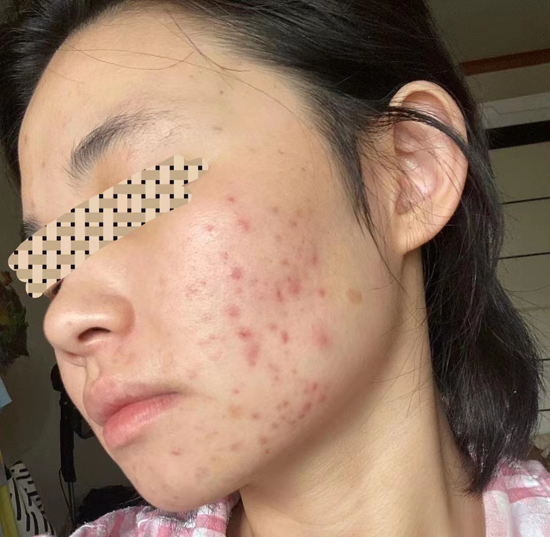 大片痤疮红痘印最快的治疗方法,痘痘反复长脓包不停如何正确祛痘