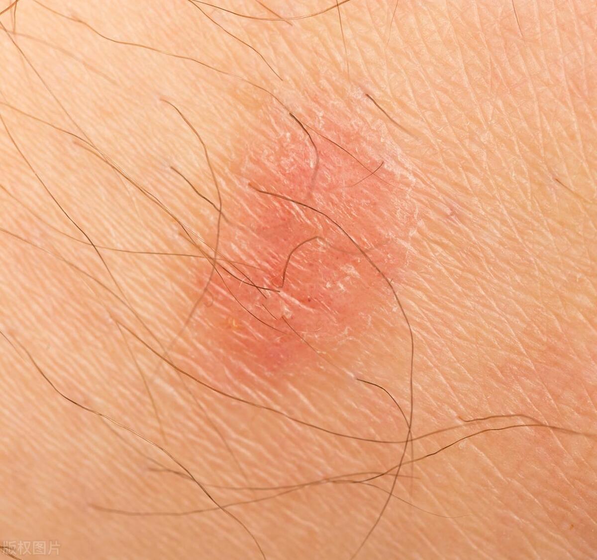 女士怎么确诊得了淋病,女生去医院检查有没有得淋病