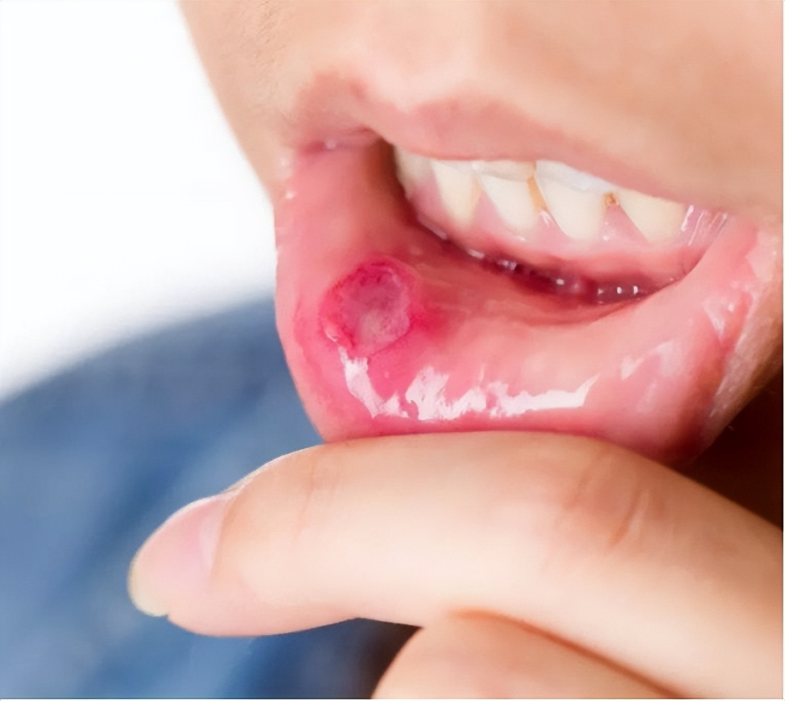 口腔溃疡喝维c泡腾片有用吗,孩子口腔溃疡可以喝维c泡腾片吗