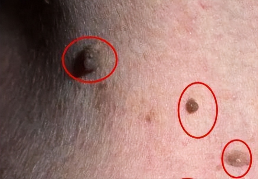 脖子和腋下的小肉粒可以揪了吗,脖子上的小肉粒揪掉后会怎样