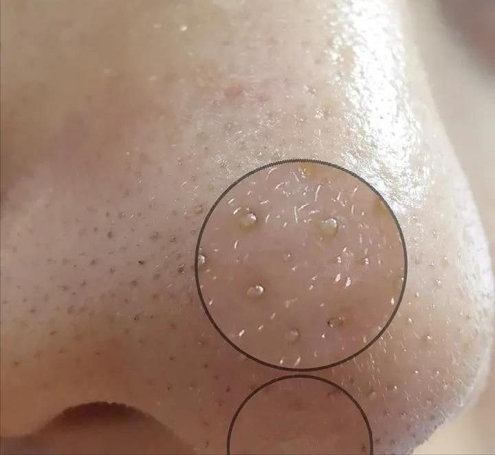 鼻子上有白白的小点可以挤吗,鼻子上黑黑的小点点怎么去除