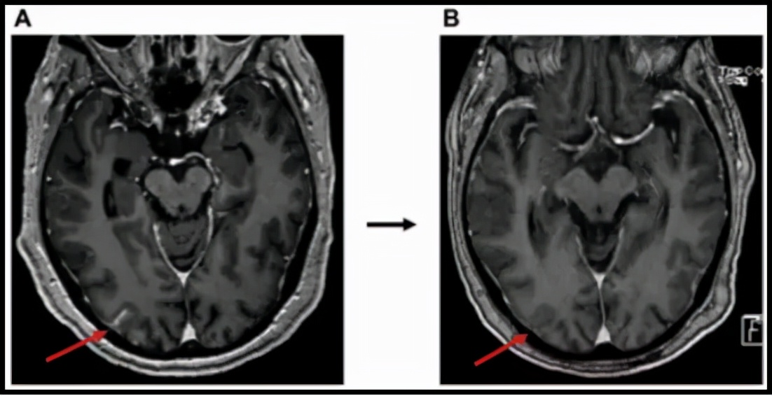 奥希替尼耐药后做哪些基因检测 (一文解析奥希替尼耐药最新方案)