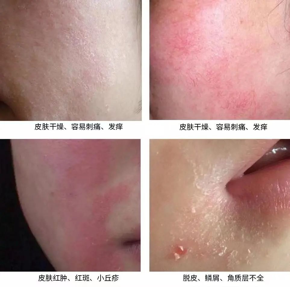 你的敏感肌怎么好的,你的敏感是一种自我保护