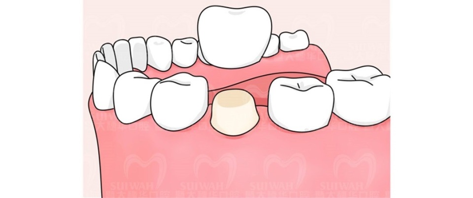 中山大学附属口腔医院牙缝修复,苏州华夏口腔修复牙缝