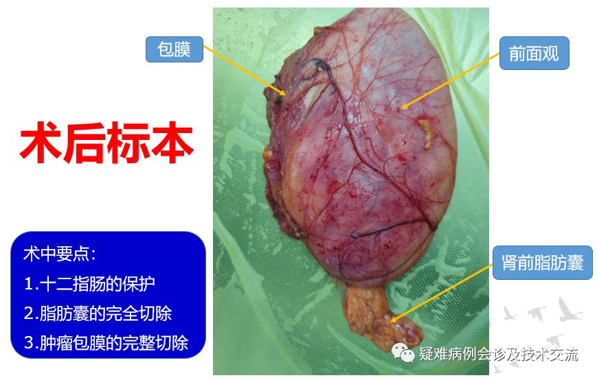 腹膜脂肪肉瘤治愈案例,原发性腹膜后脂肪肉瘤的综合治疗