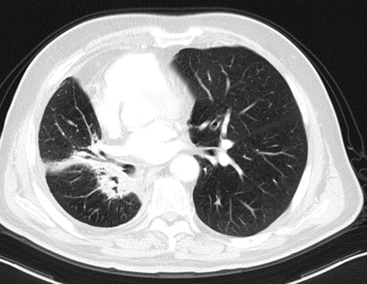 肺癌术后复发胸膜转移,肺癌术后复发转移还需要治疗吗