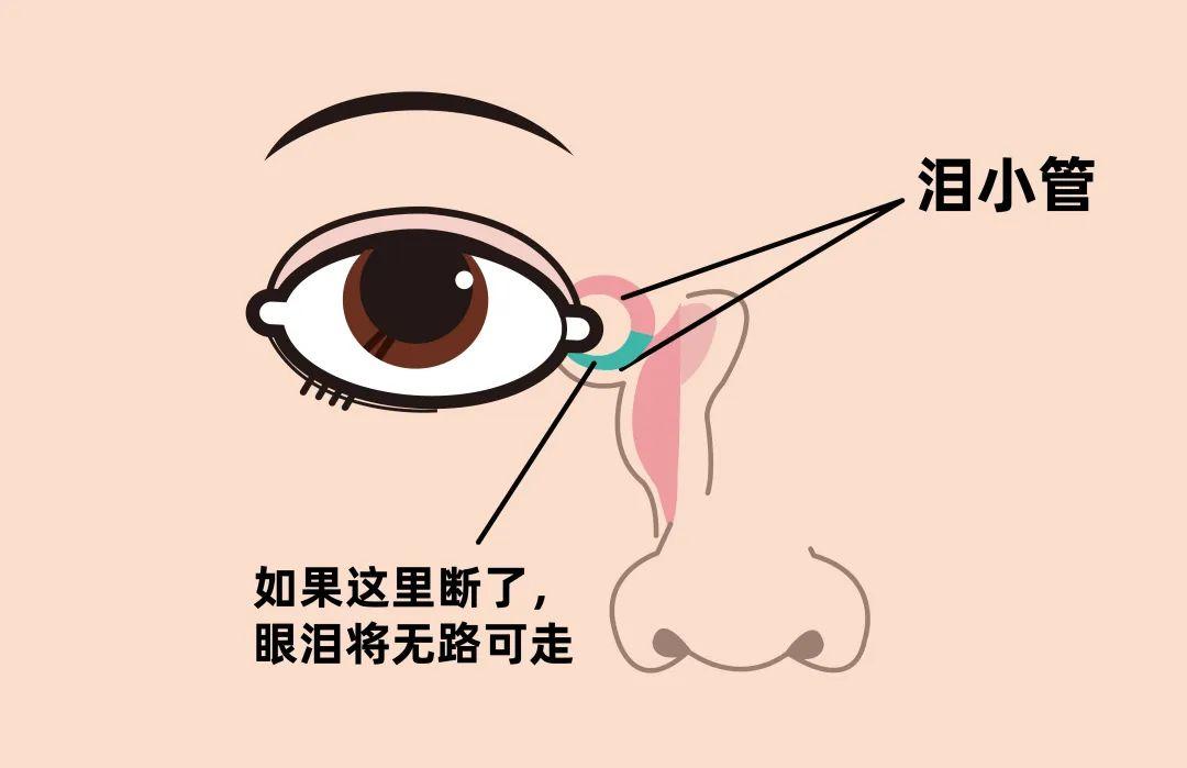 小孩眼睛外伤导致鼻泪管断裂,小孩左眼泪管断裂