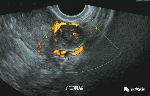 做阴道B超是一种什么样的体验?