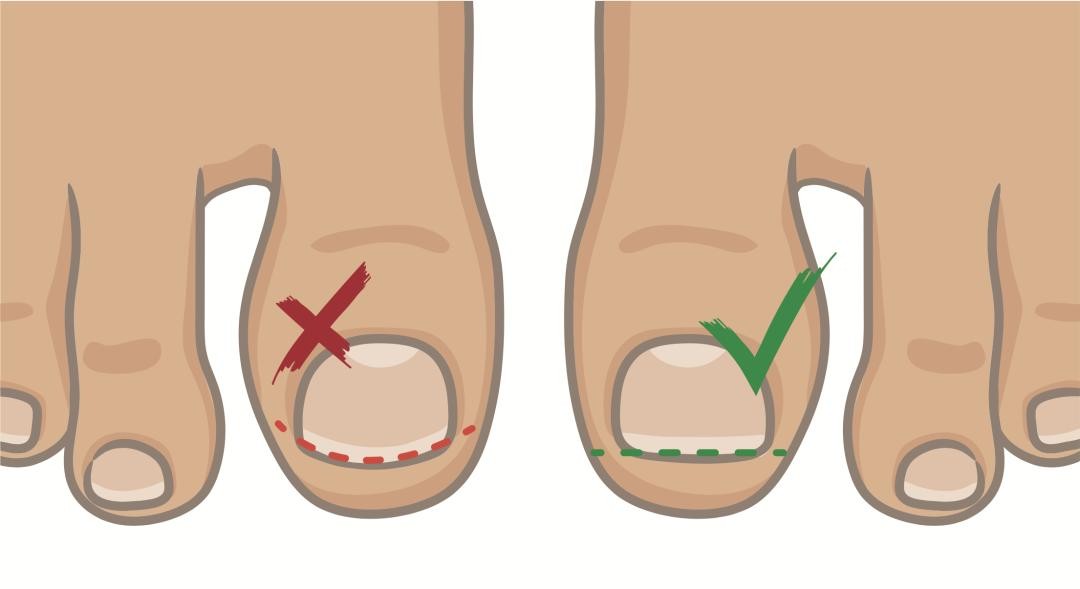 甲沟炎痛的无法剪指甲怎么办,甲沟炎清理过了为什么还是痛