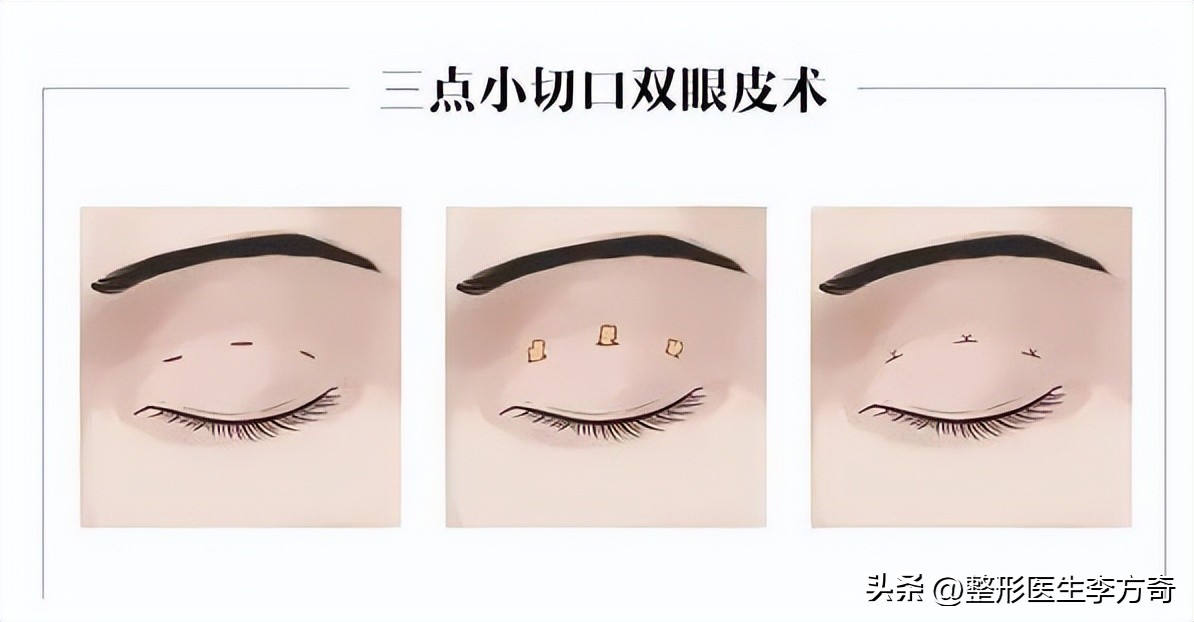 双眼皮小切口和全切的区别,双眼皮有几种术式