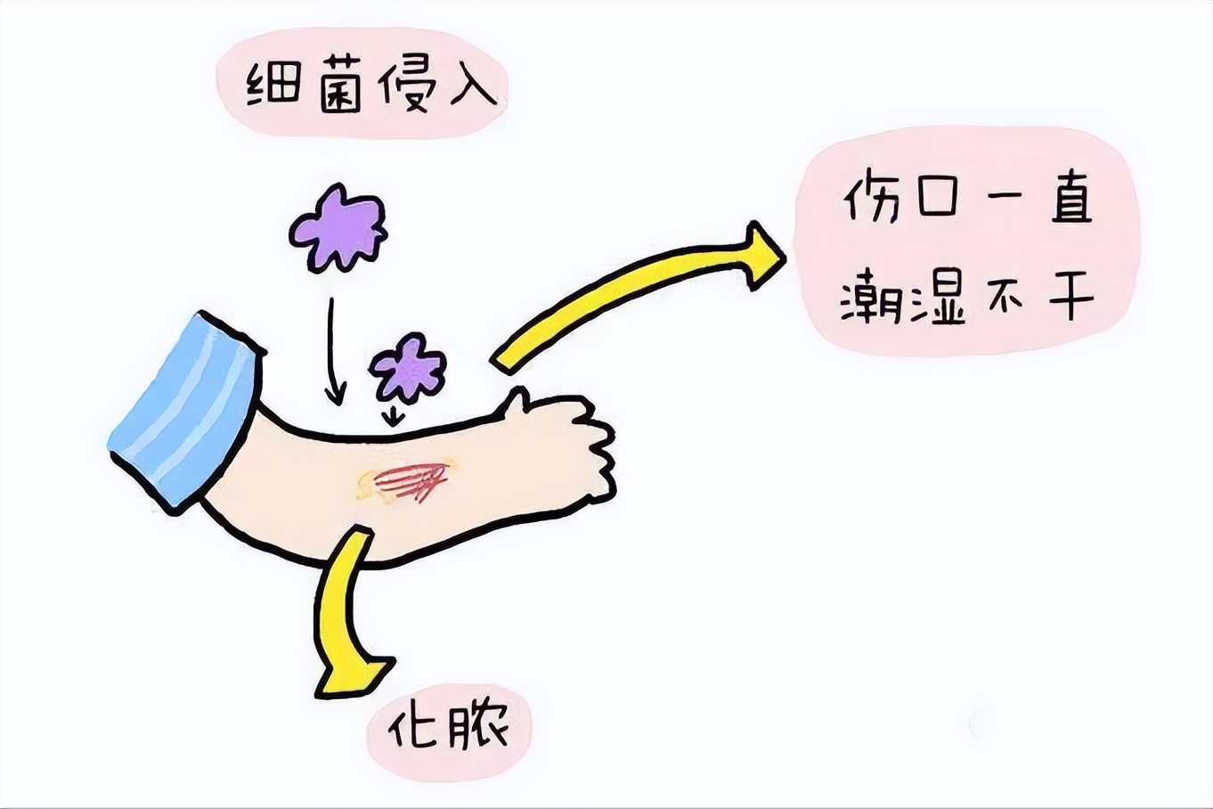 伤口湿性愈合和干性愈合的区别,干性愈合过程