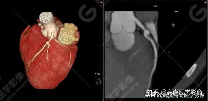 超声心动图可以用来诊断川崎病吗,心脏川崎病cta