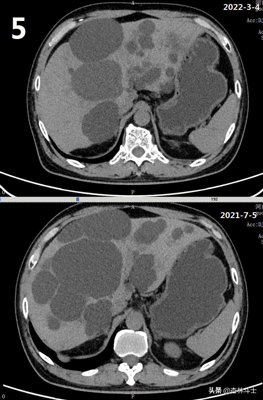 64岁银行职员患肝囊肿,CT引导下细针穿刺抽吸酒精硬化解决大问题