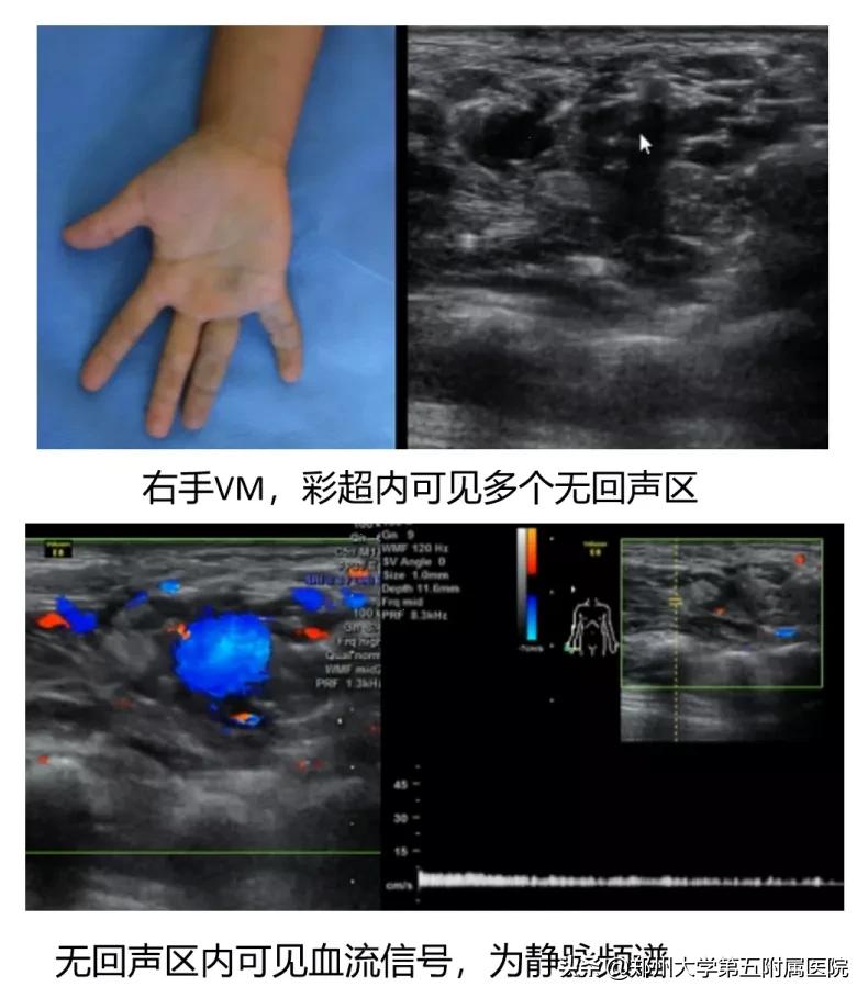 健康科普治疗结节,静脉畸形有硬肿块要做手术吗