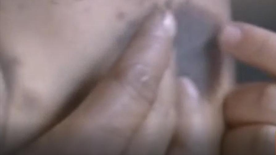 割皮救子父亲康复情况,儿子刚出生为弟弟捐骨髓后续