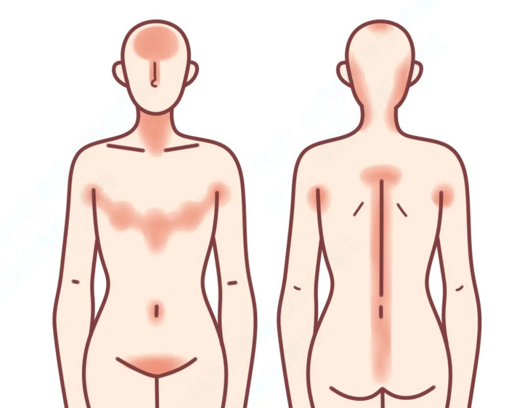 洗完澡身上痒还起皮是怎么回事,洗完澡皮肤干燥起皮浑身痒