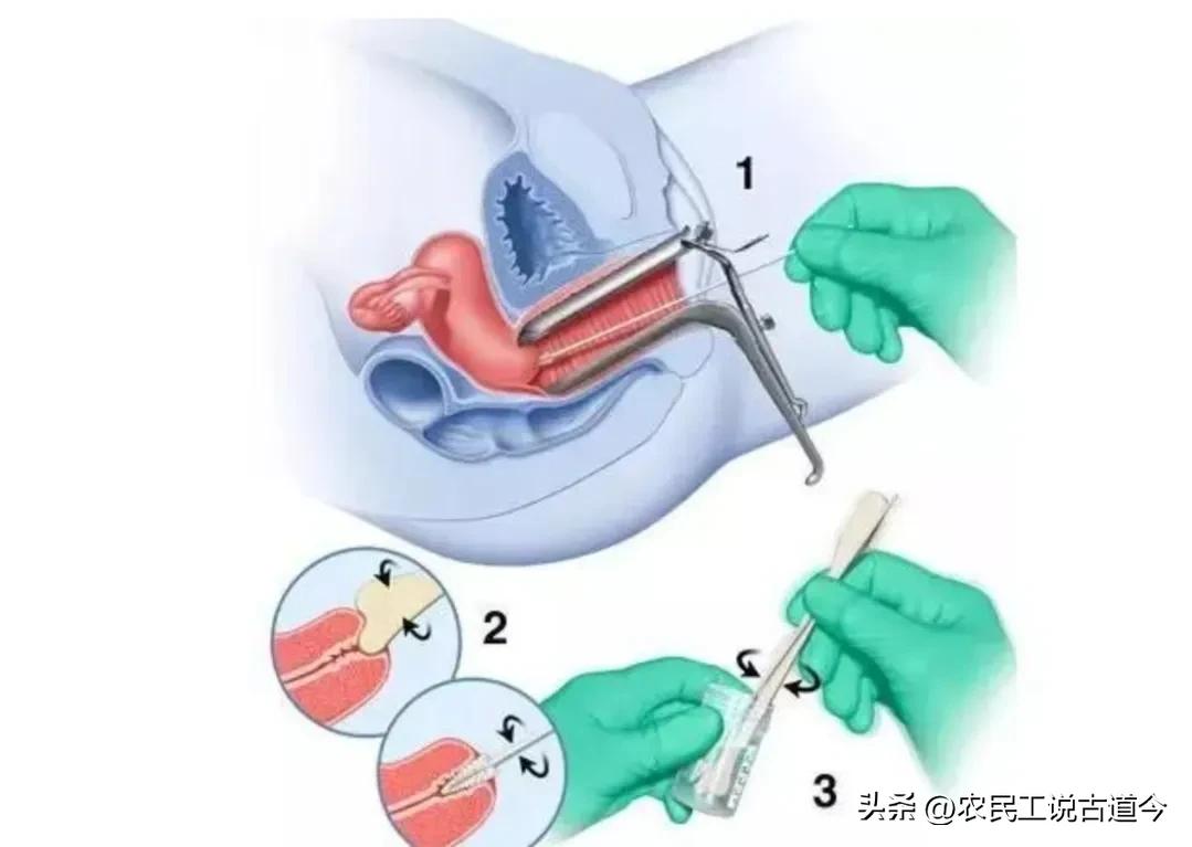 宫颈活检结果和锥切病理结果区别,宫颈活检结果报告减号