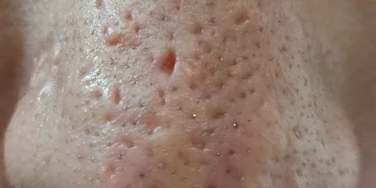 为什么鼻子可以挤出很大的黑头,用夹子挤出鼻子黑头