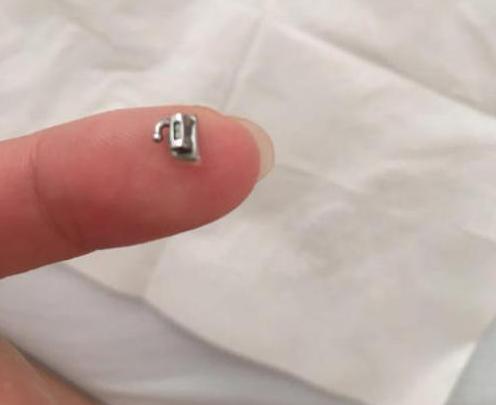 明明很小心却还是出问题,托槽如果频繁掉有哪些方案