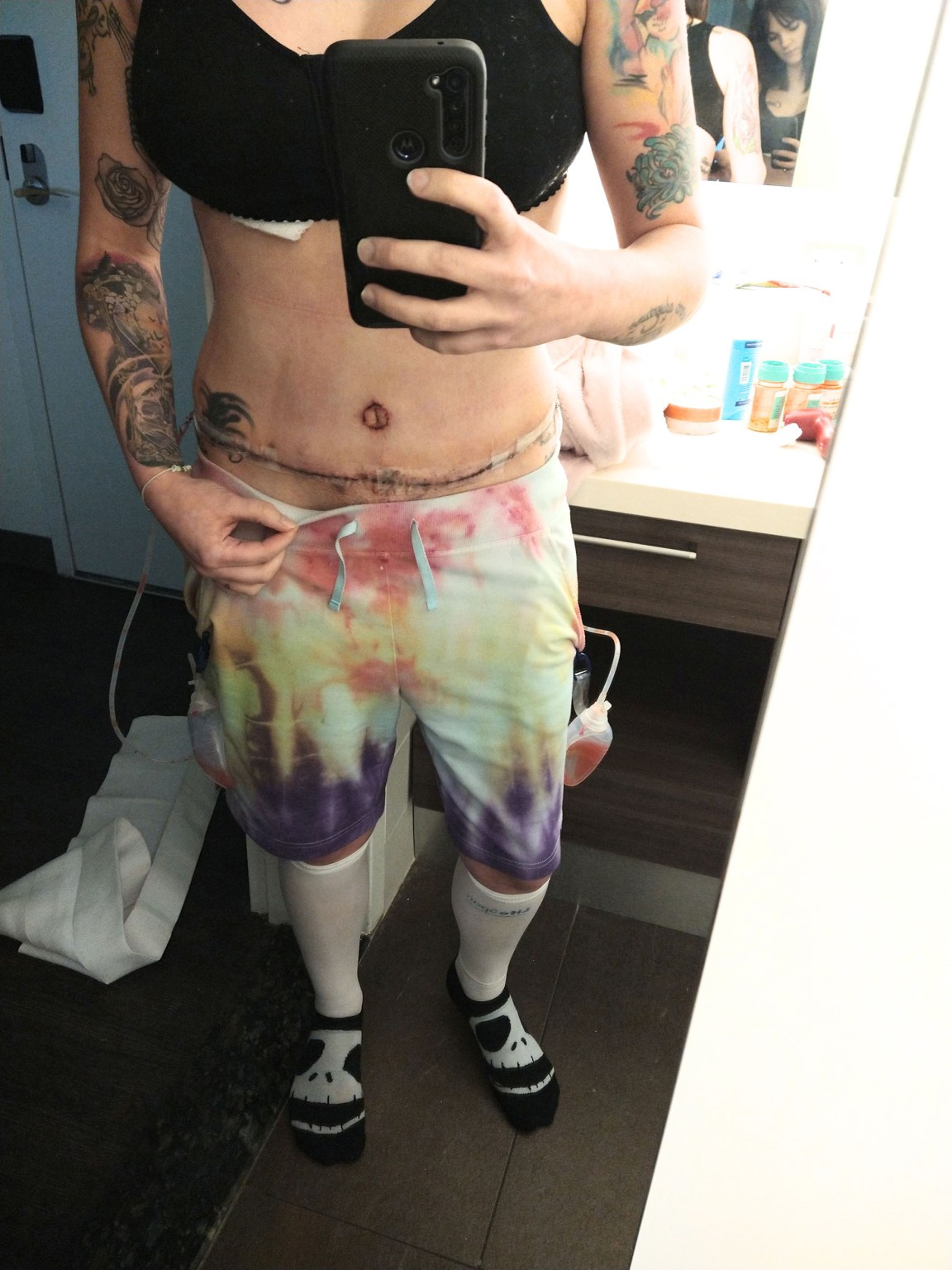 女士缩胸整形手术,美国辣妈做缩胸手术