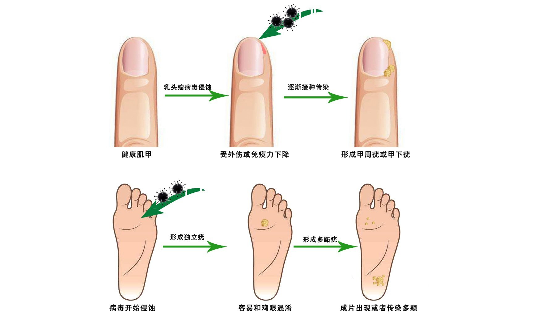 跖疣hpv有疫苗吗,跖疣hpv感染可以打hpv疫苗吗