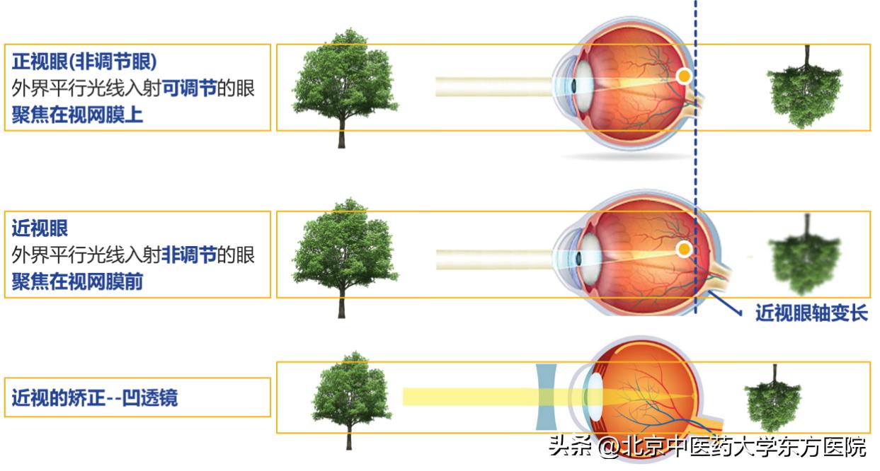 全国爱眼日治疗近视有优惠吗,世界爱眼日主题