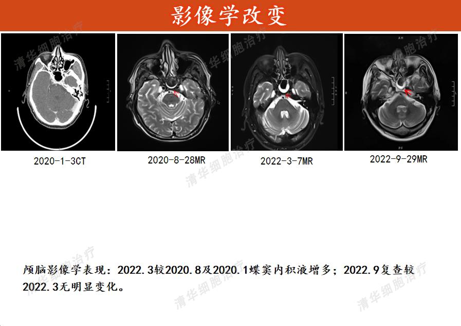 鼻咽癌放疗25次的报告,鼻咽癌化疗两次放疗33次严重吗