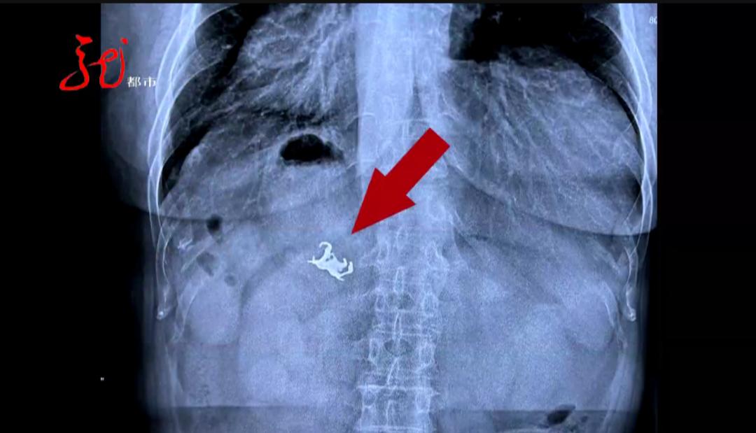 大庆一女子肚疼求医，居然看到“五个爪”！医生提醒：一定要小心