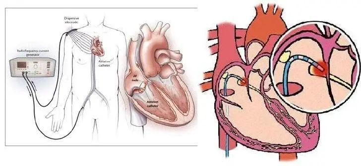 消融机器人,消融导管
