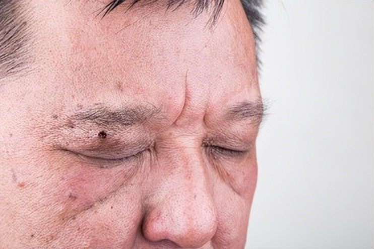 警惕这些痣可能会成瘤,哪些地方有痣代表得癌症了