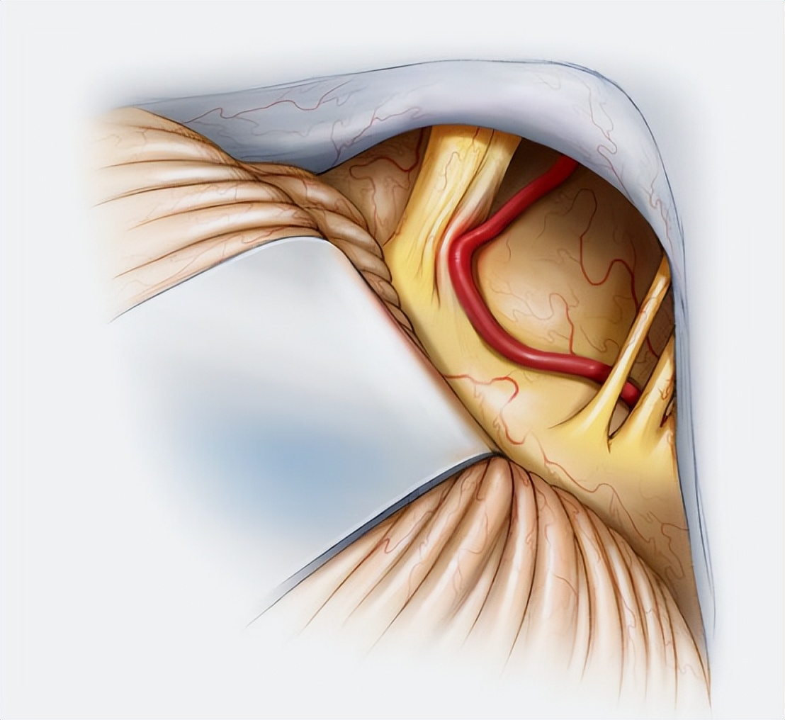 面肌痉挛会不从眼皮开始发病吗,什么是面肌痉挛该如何治疗