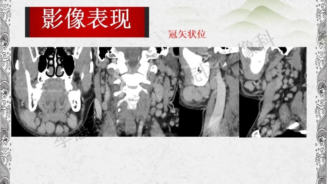 木村病治愈成功案例,木村病诊断案例