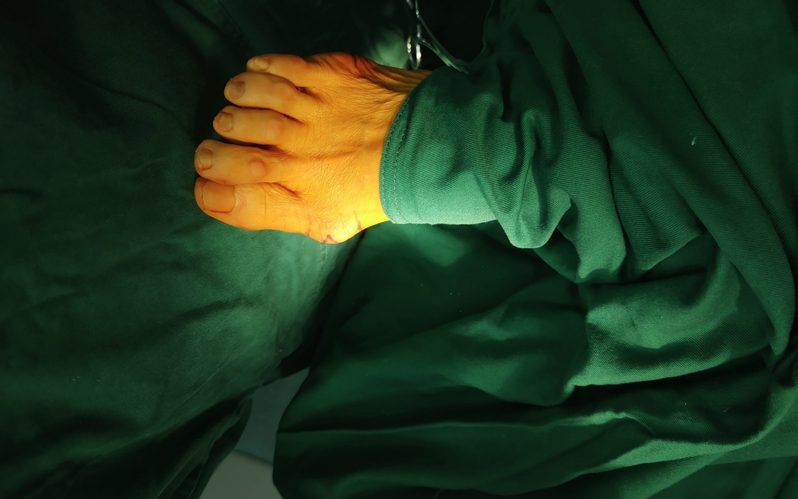 拇外翻怎么治疗呢,患了拇外翻怎么治疗比较好