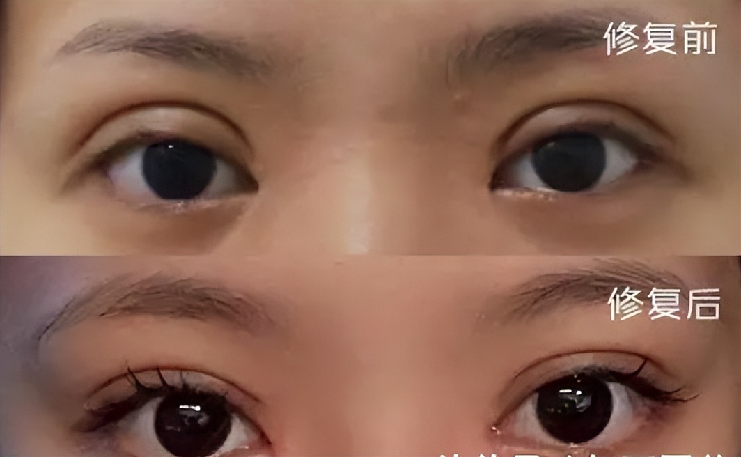 太原丽都整形医院割双眼皮好不好,太原割双眼皮正规整形医院