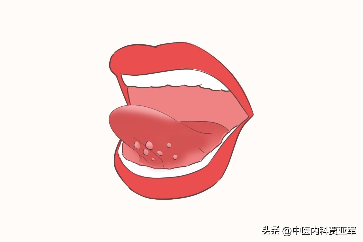 肝火旺口臭口干用什么中药,口苦口干是肝火盛要清火吃什么药