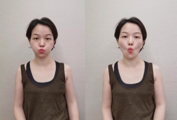 法令纹泛红暗沉做什么医美,法令纹早睡早起消除得了吗