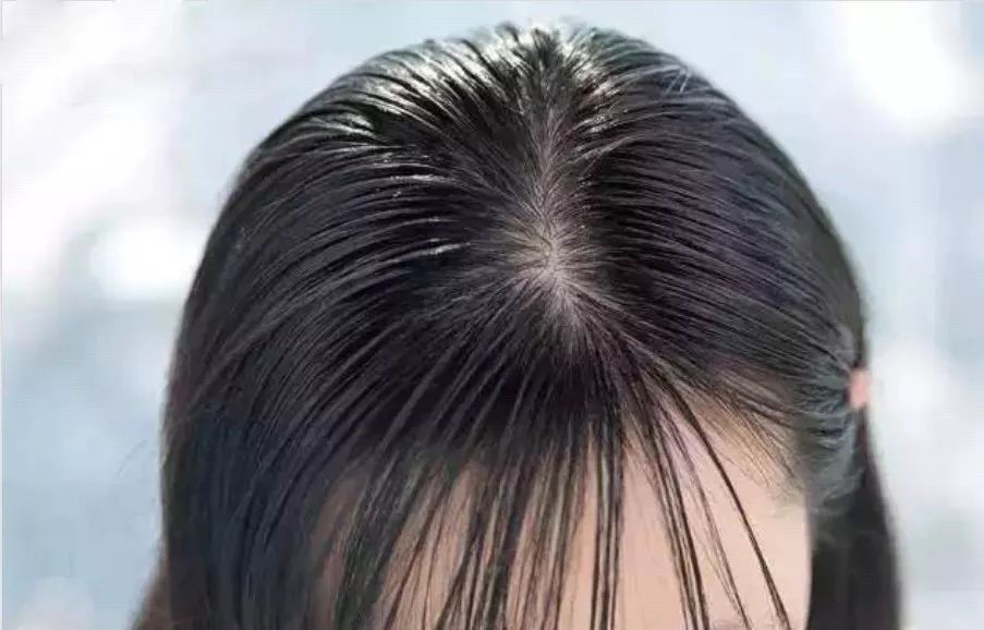 哪些因素会导致秃发,怎样可以停止斑秃继续掉发