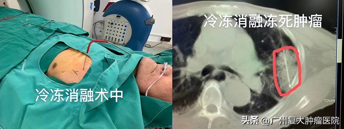 九十岁以上老人肺癌怎么办,九旬老人肺癌晚期咳痰怎么办