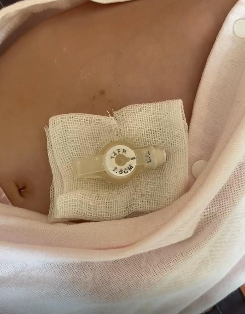 一针70万的救命药后续,70万一针救命药背后完整版