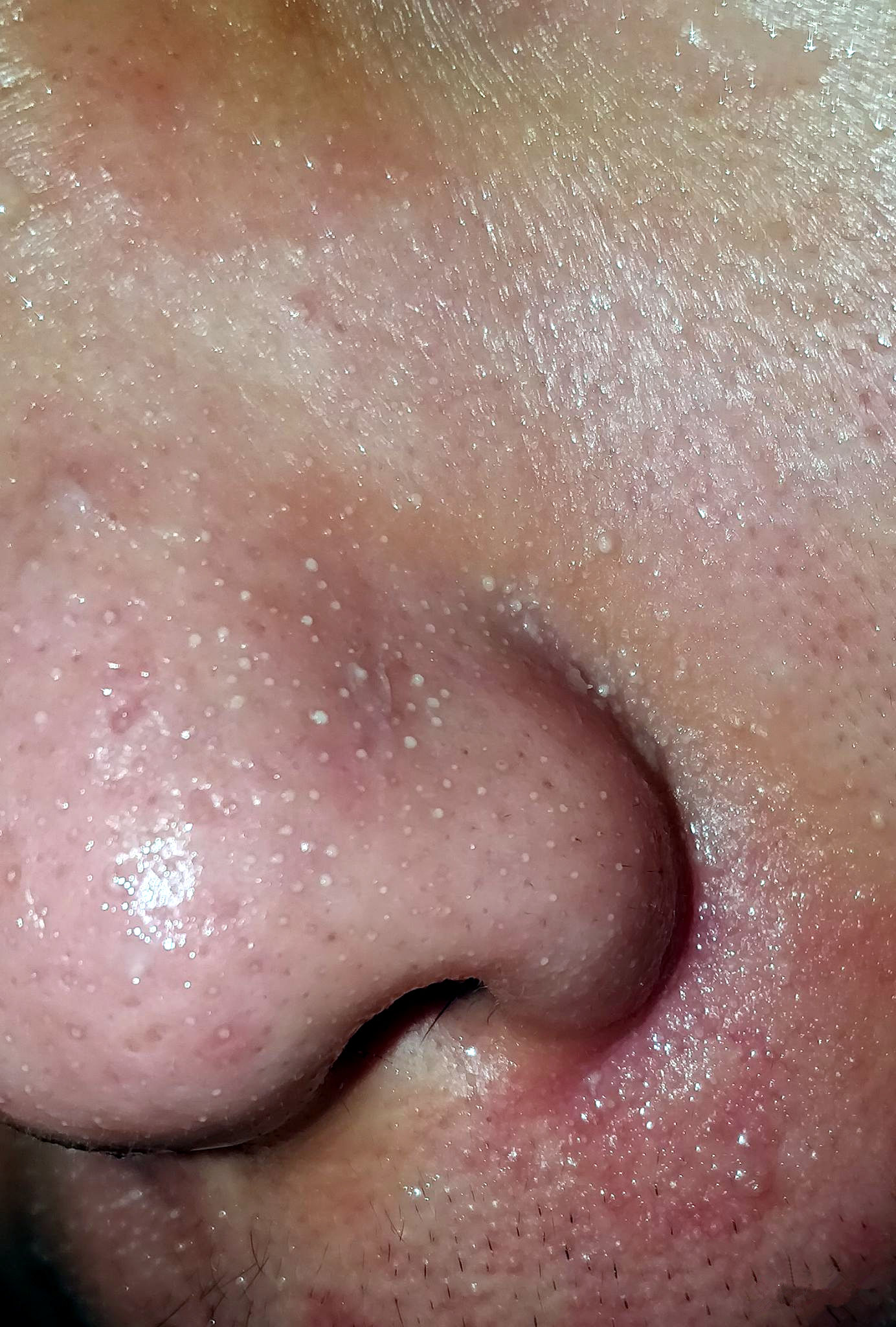 鼻头长黑粉刺怎么回事图片,鼻梁及两侧起了闭口粉刺