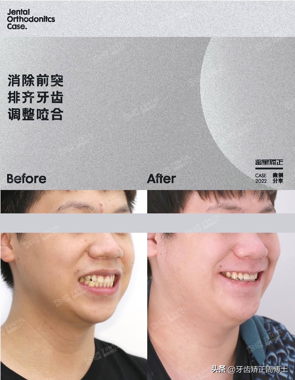 小孩牙齿为什么迟迟不长,孩子牙齿刚长出来不齐怎么办