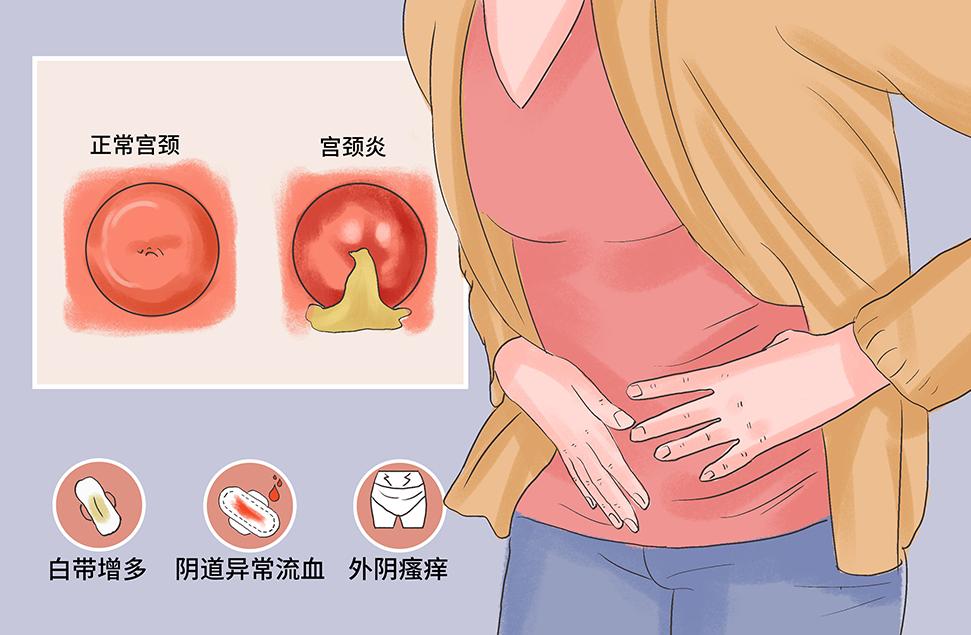 *处私**不规律出血原因很多，最坏的可能会是宫颈癌