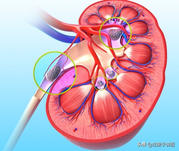 金钱草海金沙鸡内金治结石效果,金钱草海金沙鸡内金治结石