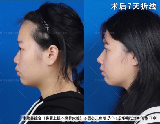 常见鼻部整形美容项目,整形鼻和自然鼻