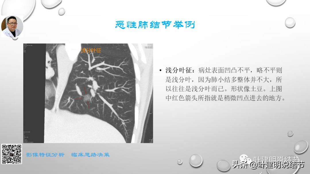 在《一脉阳光》呼吸影像诊断专题培训班上的讲课PPT（第一部分）